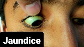 How Jaundice Looks Like [upl. by Enomys]