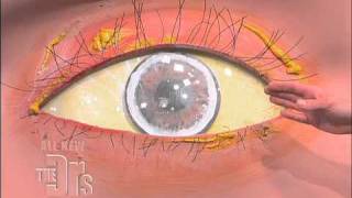 Cholesterol Deposits in the Eye The Doctors [upl. by Ogir683]