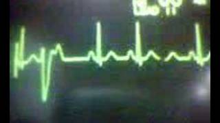 ECG Video Ectopics  Ventricular unifocal [upl. by Oeht]