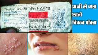 Acivir 200 DT Tablet  Aciclovir 200mg Tablet  Acivir 200mg DT Tablet मुंह के ऊपर छाले बदन पे छाले [upl. by Dickens631]