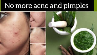 Neem face pack for Acne and PimplesNeem face pack at home [upl. by Ellison]