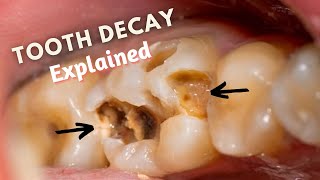 What Causes TOOTH DECAY  Know How CAVITIES Develop [upl. by Ardnasyl]