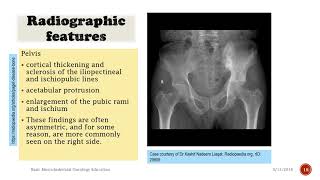 Pagets Disease How to Recognize Medical Documentary [upl. by Ponzo]