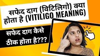 सफेद दाग कैसे ठीक होता है what is vitiligo treatment of vitiligo life with vitiligo [upl. by Attenhoj]