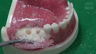 Dental Implant Hands On training video [upl. by Emlynn]