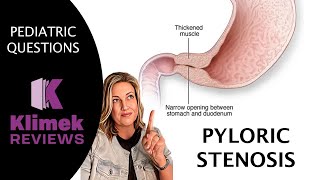 PYLORIC STENOSIS  questions with Dr Sharon [upl. by Raffarty]