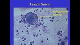 Tzanck smear Positive [upl. by Ashford]