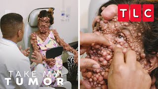 A OneOfAKind Case of Neurofibromatosis  Take My Tumor  TLC [upl. by Chatterjee]