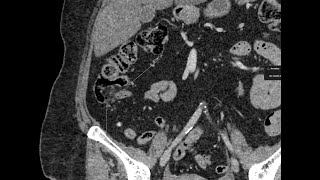 Lipomatosis of the ileocecal valve [upl. by Whitnell]