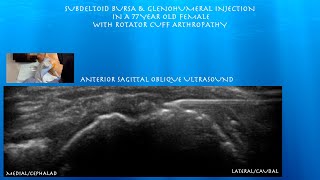 Ultrasound Guided Subdeltoid Bursa Glenohumeral injection in a Female with Rotator Cuff Arthropathy [upl. by Aihsinyt]