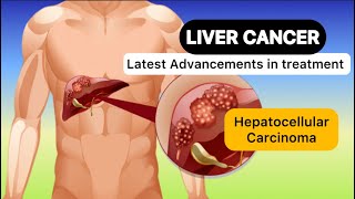 LIVER CANCER OR Hepatocellular Carcinoma  LIVER CIRRHOSIS  Causes  Signs Symptoms  Treatment [upl. by Sculley]