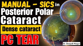 MSICS in Posterior Polar Cataract PC Tear Can we prevent Anterior Hyaloid rupture DrDeepak Megur [upl. by Weinert]