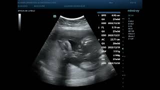 Placenta abruption  Diagnostic ultrasound cases [upl. by Margarethe]