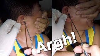 Removing Boys Hard Earwax  Look How Difficult It Is to Remove It [upl. by Toby]