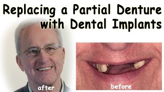 Replacing a Partial Denture with Dental Implants [upl. by Stelu]