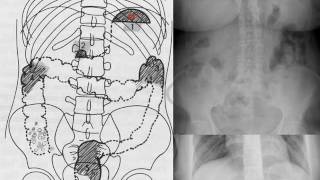 imagerie des urgences digestives partie 1 [upl. by Ioved]