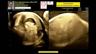 Makrosomia bayi extreme besar 33 weeks [upl. by Filipe207]