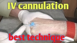 cannulationIV annulation cannula techniquecannula procedure [upl. by Rothberg]