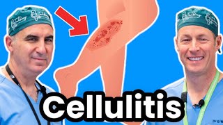 Cellulitis Explained By Infectious Disease Doc Red Sore And Swollen [upl. by Farly]