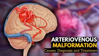 Arteriovenous Malformation Causes Signs and Symptoms Diagnosis and Treatment [upl. by Oramlub]