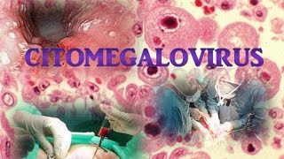 Citomegalovirus [upl. by Annawt]