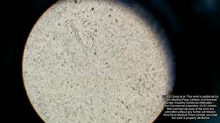 Misdiagnosed disseminated strongyloidiasis case  Supplementary video 1 ID 381298 [upl. by Vito]