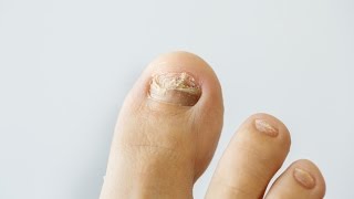 How to prevent and treat nail fungus [upl. by Myo]