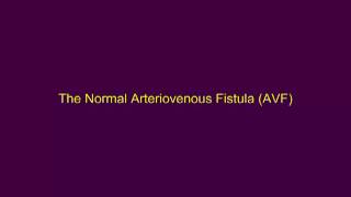 The Normal Arteriovenous Fistula [upl. by Siriso513]