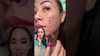 Satisfying Chemical Peel Part II [upl. by Laurens]