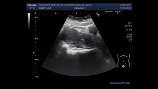 Ultrasound Video showing Cervicitis with dilated cervix uteri [upl. by Nemzaj499]