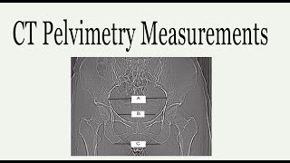 CT Pelvimetry Measurements [upl. by Nickola]