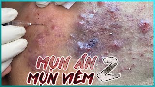 Big Cystic Acne Blackheads Extraction Blackheads amp Milia Whiteheads Removal Pimple Popping [upl. by Eentihw360]