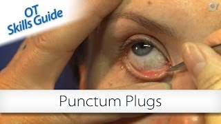 OT skills guide punctum plugs [upl. by Gmur923]