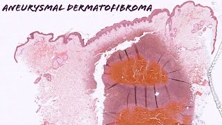 Aneurysmal dermatofibroma dermatofibroma with internal hemorrhage pathology dermpath dermatology [upl. by Tterej]