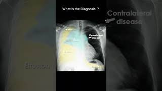 Lung cancer  Disease progression 77 radiologychannel007 [upl. by Axia]