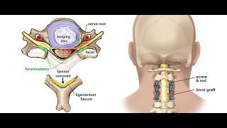 Spine Approaches 5 Posterior Approach to SubAxial Cervical Spine [upl. by Karine]