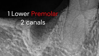 Endodontic treatment Lower premolar 2 canals [upl. by Housen]