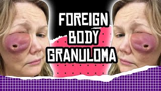 Weird Health News Foreign Body Granuloma [upl. by Ahsets]