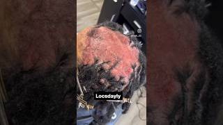 Sensitive Scalp Transformation 😱 [upl. by Celeste14]