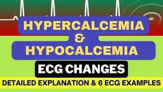 Hypercalcemia and Hypocalcemia ECG changes with 6 Examples Mechanism and Detailed Explanation [upl. by Hanselka661]