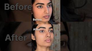 LIP HYPERPIGMENTATION Peeling off  Removal journey [upl. by Glynda]