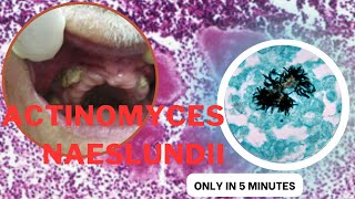 actinomyces microbiology lecture actinomyces naeslundii Easy Microbiology [upl. by Animaj]