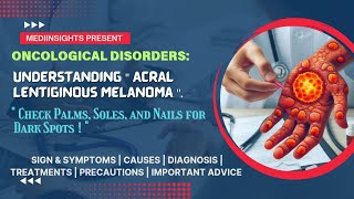 Understanding Acral Lentiginous Melanoma Symptoms Causes Diagnosis and Treatment  MediInsights [upl. by Agle226]