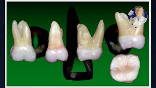 Módulo I  Aula 3 Cirurgia de Acesso  Molares Superiores [upl. by Aleira]