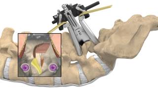 MAS® TLIF Patient Animation [upl. by Kelvin]