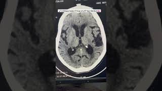 A Glimpse Inside CT Scan of a 97YearOld Brain 🧠 medical ctscan radiology neurology medicine [upl. by Noryv]