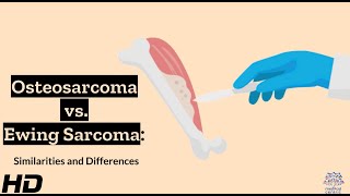 Osteosarcoma vs Ewing Sarcoma A Comparative Analysis [upl. by Assirolc525]