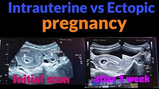 intrauterine vs ectopic pregnancy presentation I early pregnancy scan I urdu I hindi [upl. by Lupiv497]