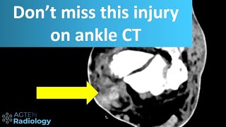 Peroneal tendon injury on CT [upl. by Jonna]