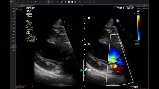 Flail AML Severe MR Severe Aortic Stenosis Continuity Equation discussion [upl. by Nauqet647]